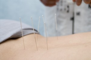 Treatment by acupuncture